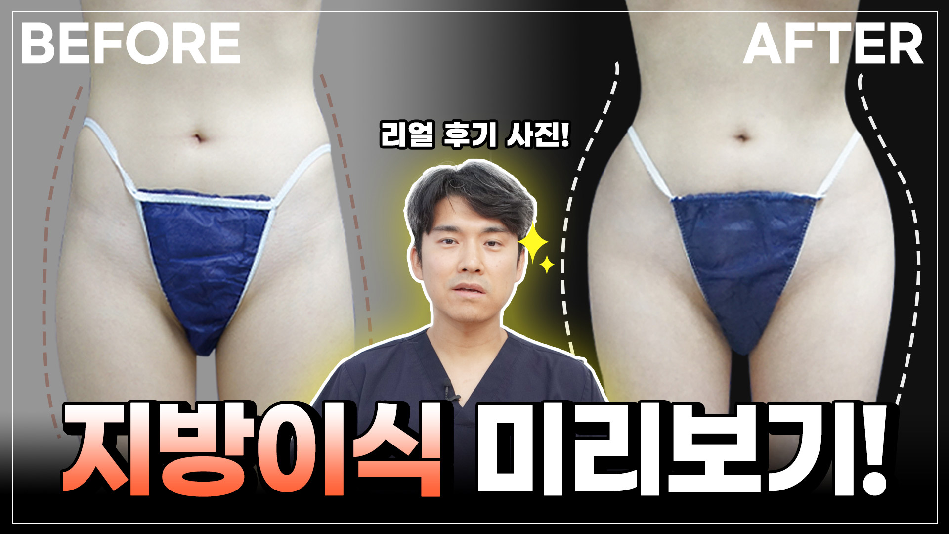 바디지방이식 케이스리뷰