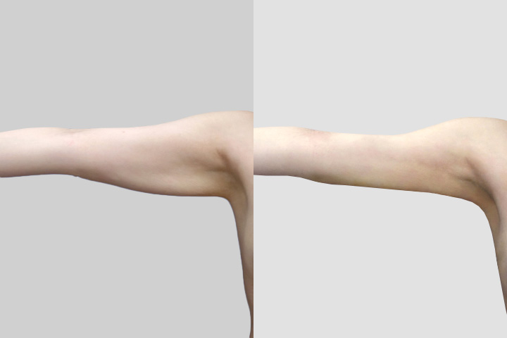 수술정보 <span>팔지방흡입