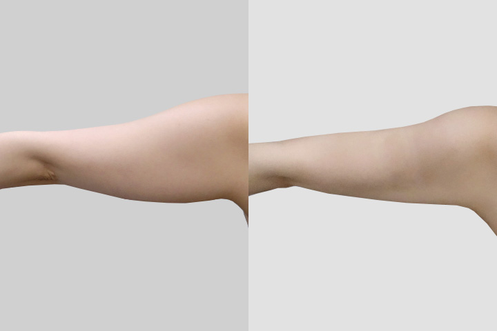 수술정보 <span>팔지방흡입