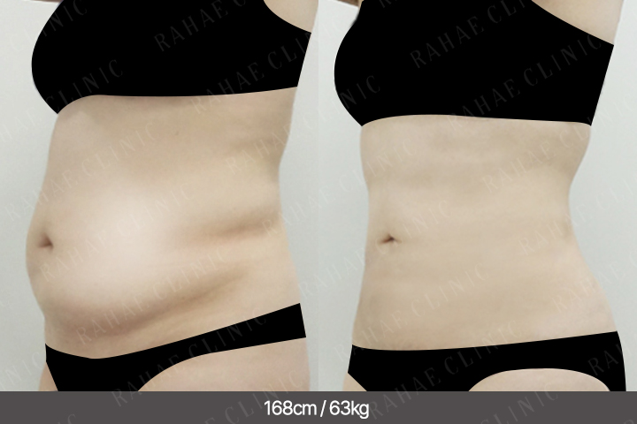 수술정보 <span>복부지방흡입