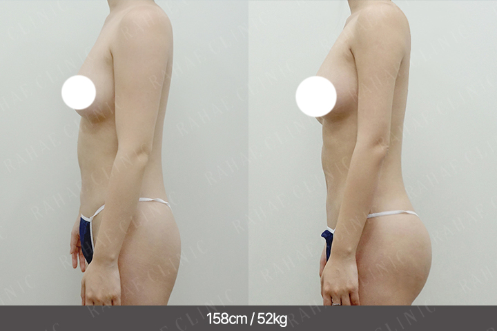 수술정보 <span>팔지방흡입+엉덩이지방이식