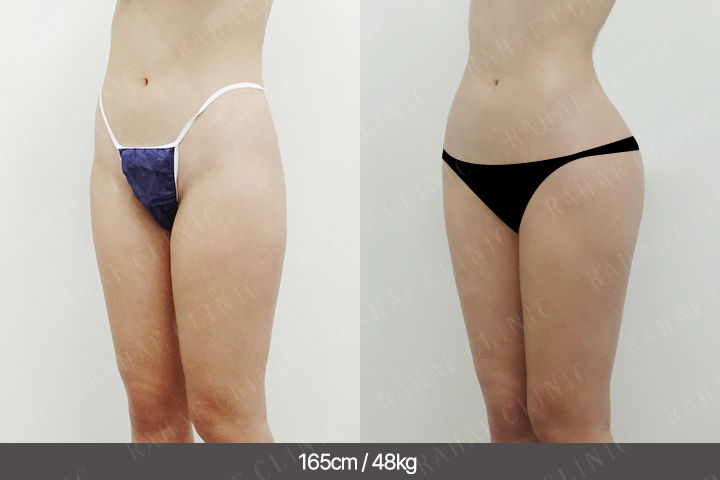 수술정보 <span>골반지방이식+엉덩이지방이식+가슴지방이식+복부지방흡입