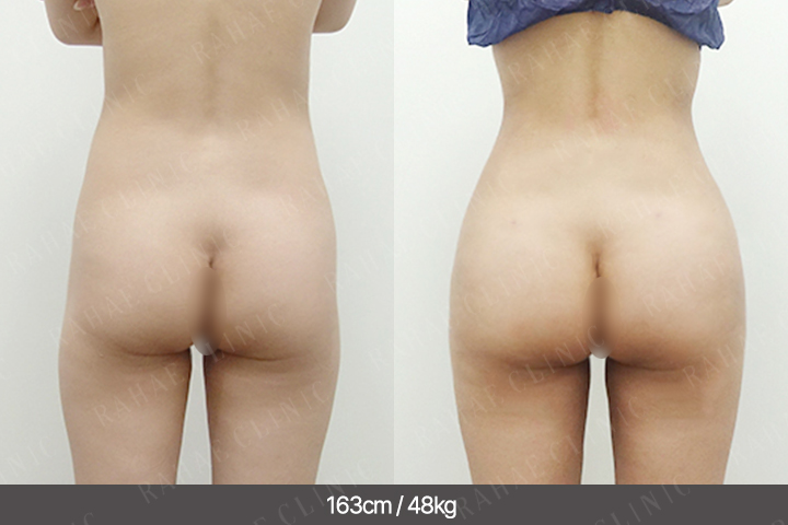 수술정보 <span>골반지방이식+엉덩이지방이식+복부지방흡입