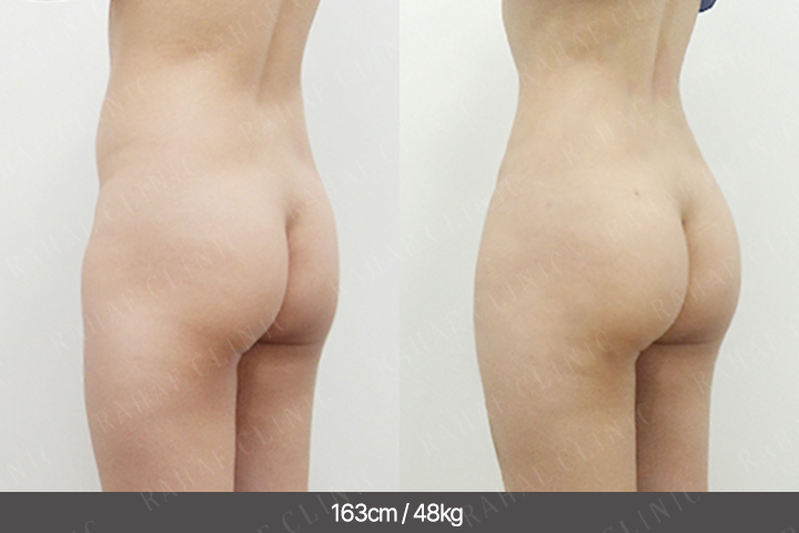 수술정보 <span>골반지방이식+엉덩이지방이식+복부지방흡입