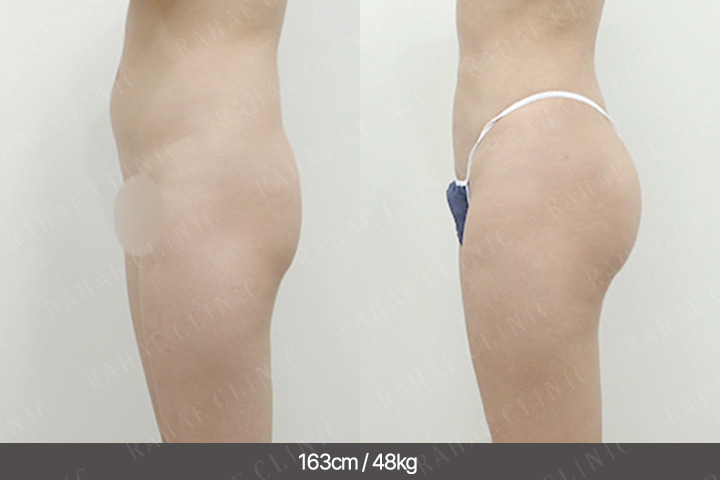 수술정보 <span>골반지방이식+엉덩이지방이식+복부지방흡입