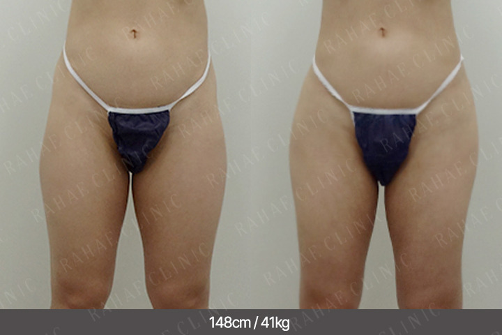 수술정보 <span>골반지방이식+허벅지지방흡입