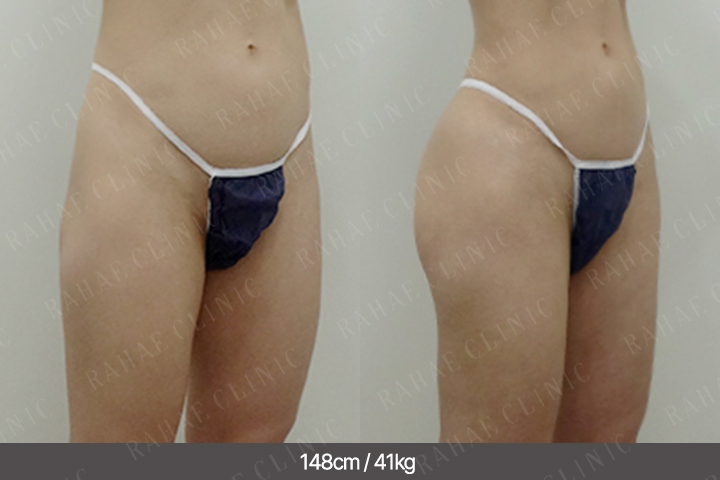 수술정보 <span>골반지방이식+허벅지지방흡입