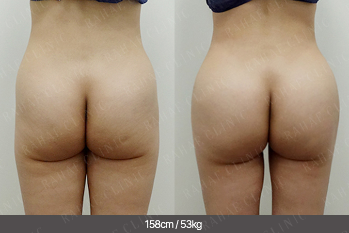 수술정보 <span>엉덩이지방이식+복부지방흡입