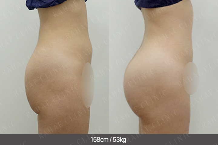 수술정보 <span>엉덩이지방이식+복부지방흡입