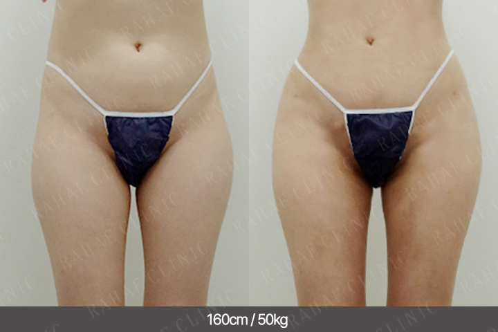 수술정보 <span>골반지방이식+엉덩이지방이식+복부지방흡입