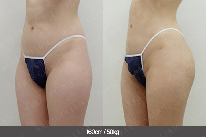 수술정보 <span>골반지방이식+엉덩이지방이식+복부지방흡입