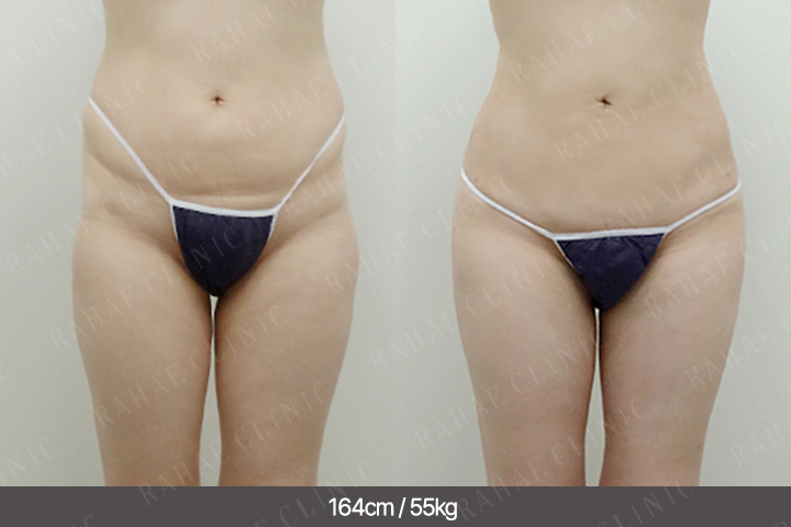 수술정보 <span>골반지방이식+복부지방흡입