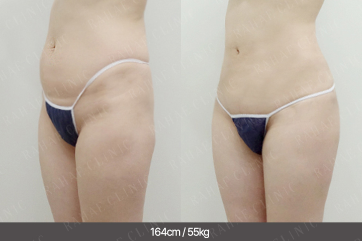 수술정보 <span>골반지방이식+복부지방흡입