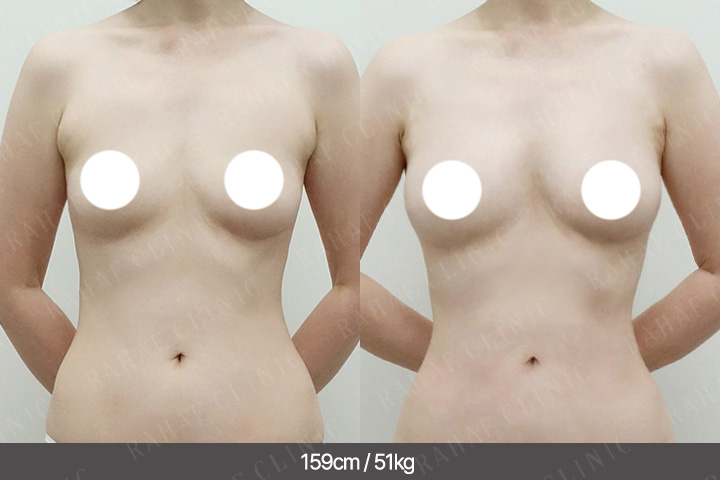 수술정보 <span>가슴지방이식+복부지방흡입