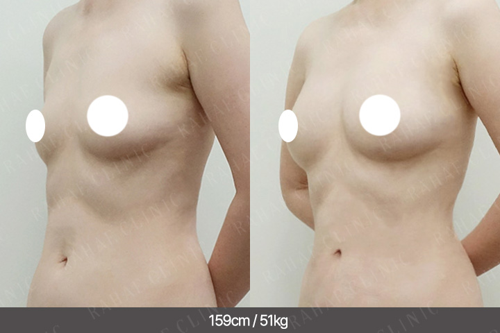 수술정보 <span>가슴지방이식+복부지방흡입
