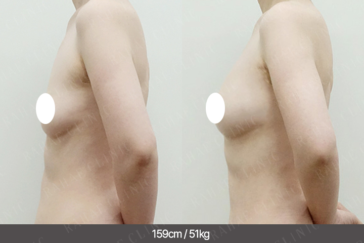 수술정보 <span>가슴지방이식+복부지방흡입