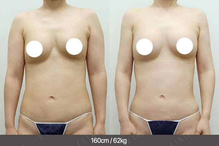 수술정보 <span>팔지방흡입+골반지방이식+엉덩이지방이식