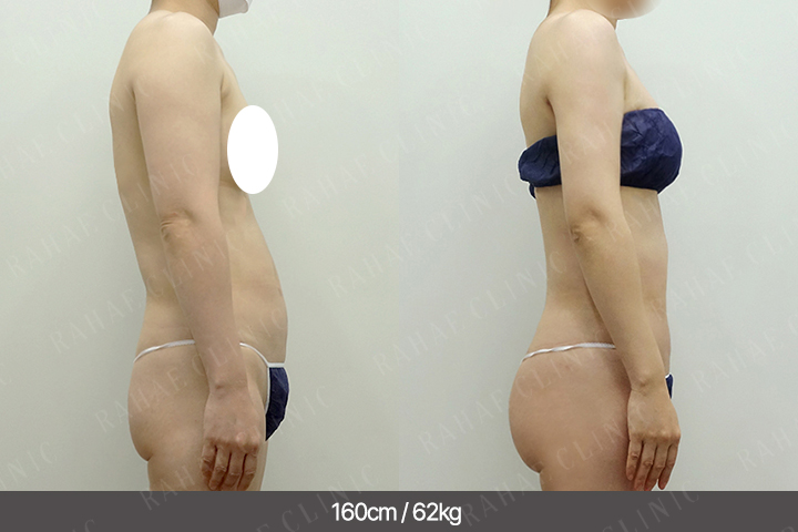 수술정보 <span>팔지방흡입+골반지방이식+엉덩이지방이식