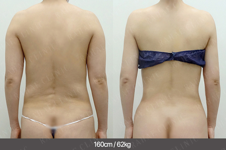 수술정보 <span>팔지방흡입+골반지방이식+엉덩이지방이식