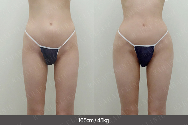 수술정보 <span>골반지방이식+엉덩이지방이식+복부지방흡입