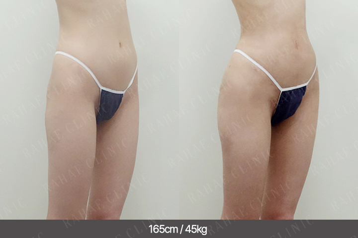 수술정보 <span>골반지방이식+엉덩이지방이식+복부지방흡입