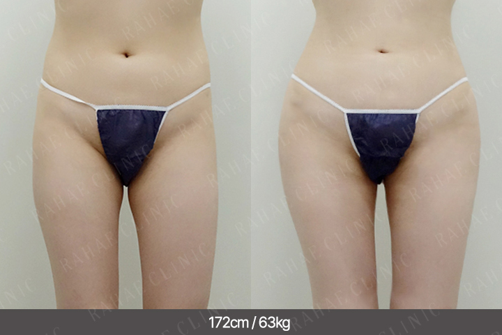 수술정보 <span>골반지방이식+엉덩이지방이식+복부지방흡입