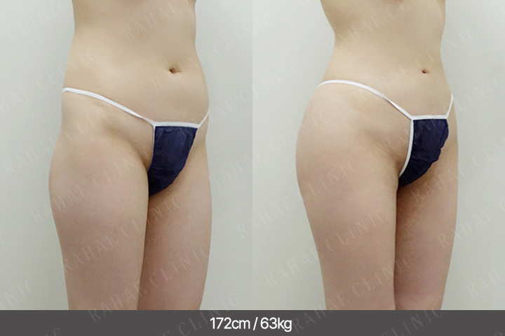 수술정보 <span>골반지방이식+엉덩이지방이식+복부지방흡입