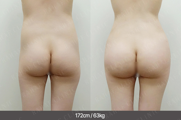 수술정보 <span>엉덩이지방이식+골반지방이식+복부지방흡입