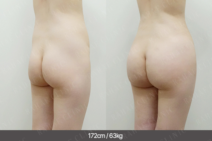 수술정보 <span>엉덩이지방이식+골반지방이식+복부지방흡입