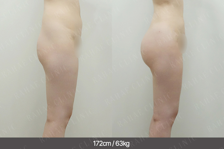 수술정보 <span>엉덩이지방이식+골반지방이식+복부지방흡입