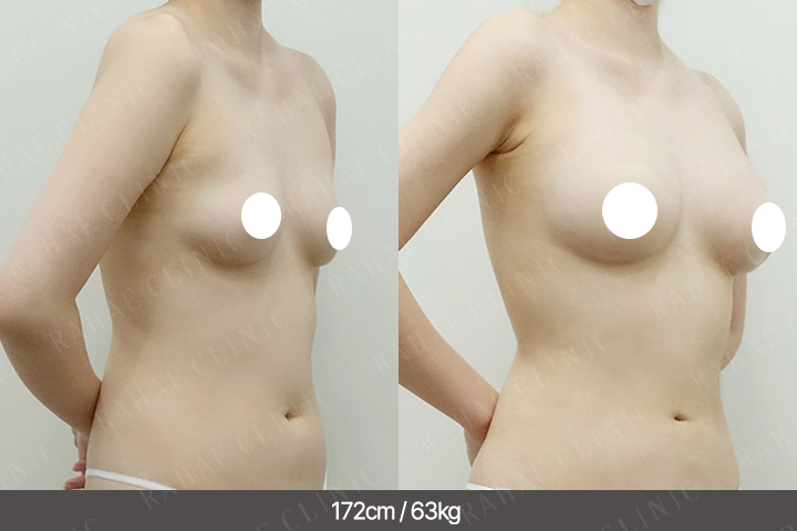 수술정보 <span>가슴지방이식+복부지방흡입