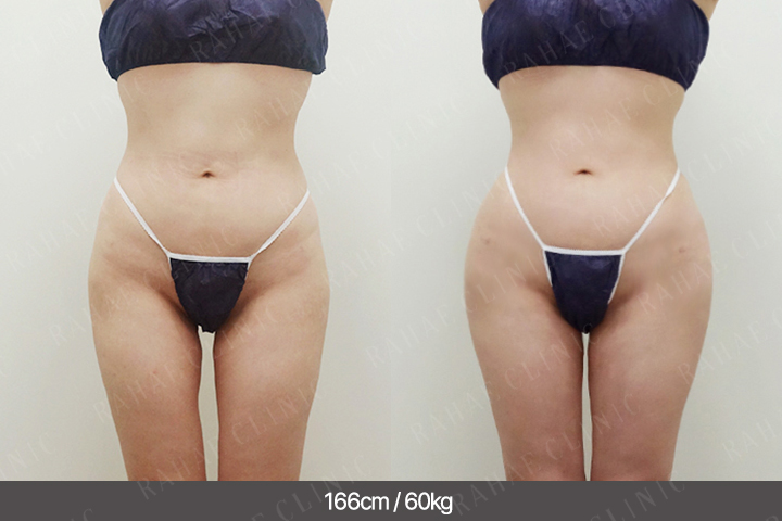 수술정보 <span>골반지방이식+엉덩이지방이식+허벅지지방흡입