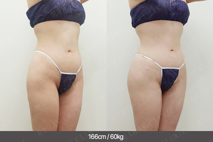 수술정보 <span>골반지방이식+엉덩이지방이식+허벅지지방흡입