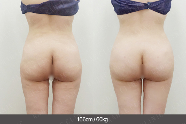 수술정보 <span>엉덩이지방이식+골반지방이식+복부지방흡입