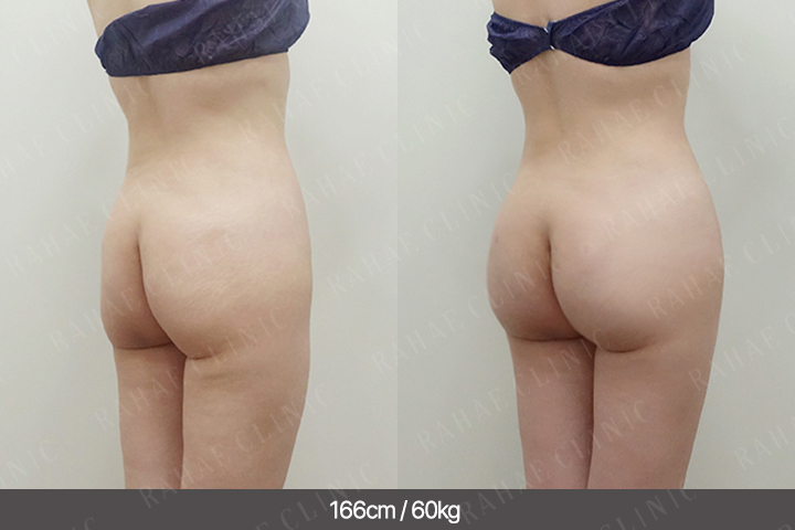 수술정보 <span>엉덩이지방이식+골반지방이식+복부지방흡입