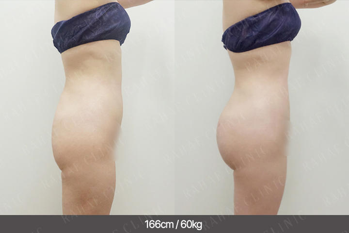 수술정보 <span>엉덩이지방이식+골반지방이식+복부지방흡입