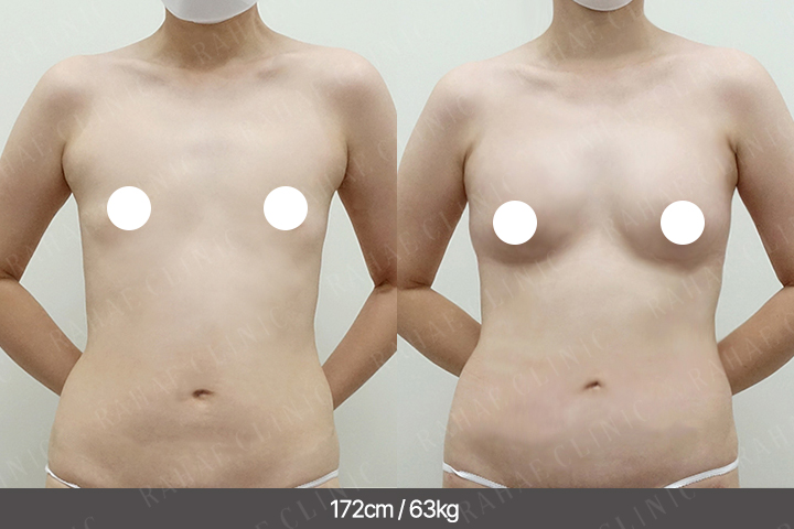 수술정보 <span>가슴지방이식+복부지방흡입