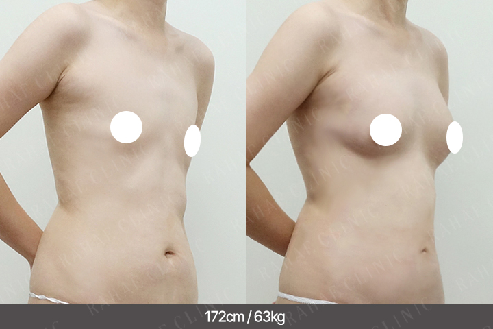 수술정보 <span>가슴지방이식+복부지방흡입