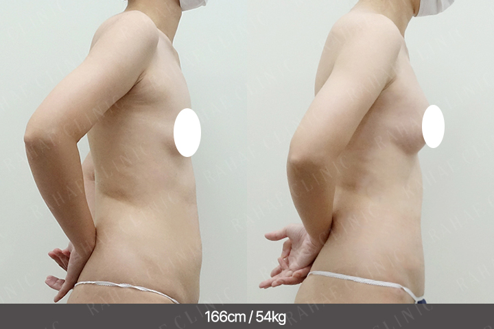 수술정보 <span>가슴지방이식+복부지방흡입