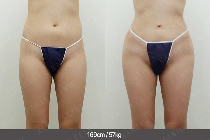 수술정보 <span>골반지방이식+복부지방흡입