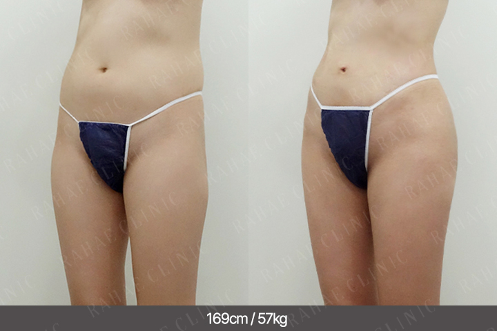 수술정보 <span>골반지방이식+복부지방흡입