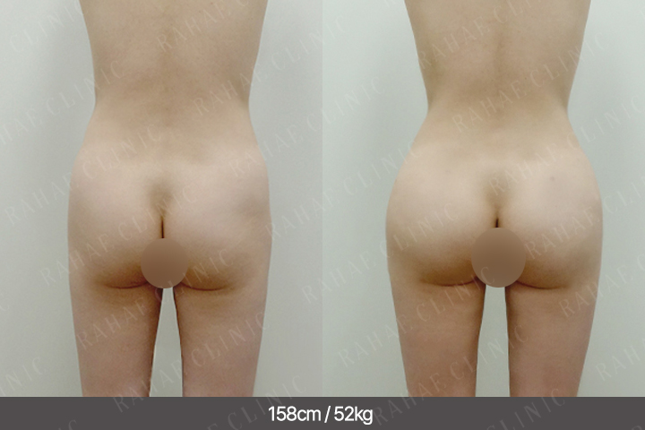 수술정보 <span>엉덩이지방이식+팔지방흡입+허벅지지방흡입