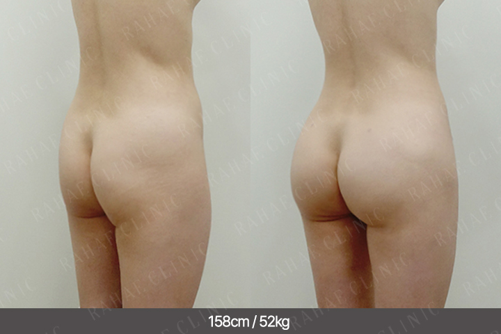 수술정보 <span>엉덩이지방이식+팔지방흡입+허벅지지방흡입