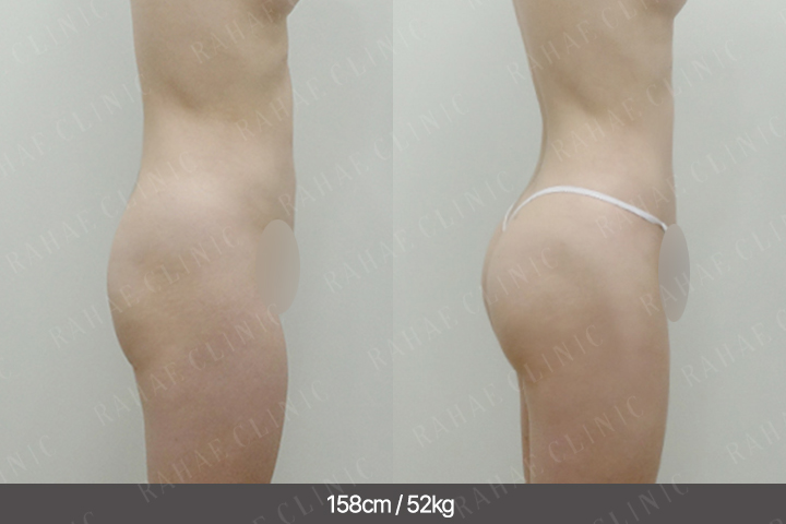 수술정보 <span>엉덩이지방이식+팔지방흡입+허벅지지방흡입