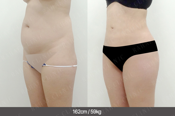 수술정보 <span>복부지방흡입+골반지방이식+엉덩이지방이식