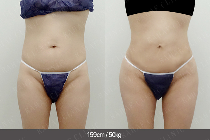 수술정보 <span>골반지방이식+엉덩이지방이식+복부지방흡입