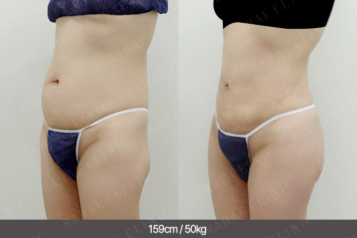 수술정보 <span>골반지방이식+엉덩이지방이식+복부지방흡입