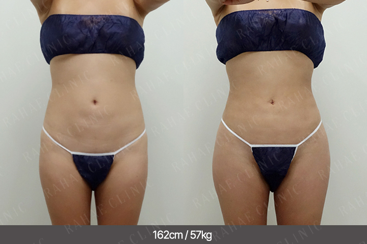 수술정보 <span>골반지방이식+엉덩이지방이식+복부지방흡입