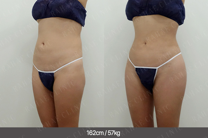 수술정보 <span>골반지방이식+엉덩이지방이식+복부지방흡입