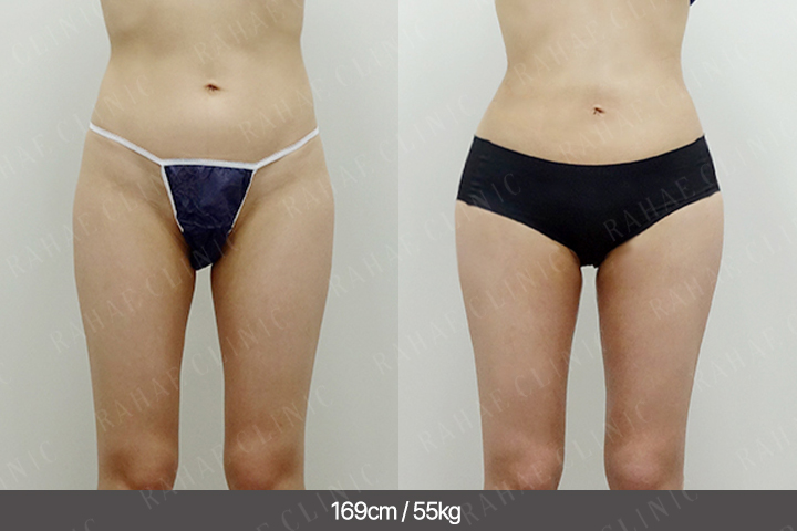 수술정보 <span>골반지방이식+복부지방흡입